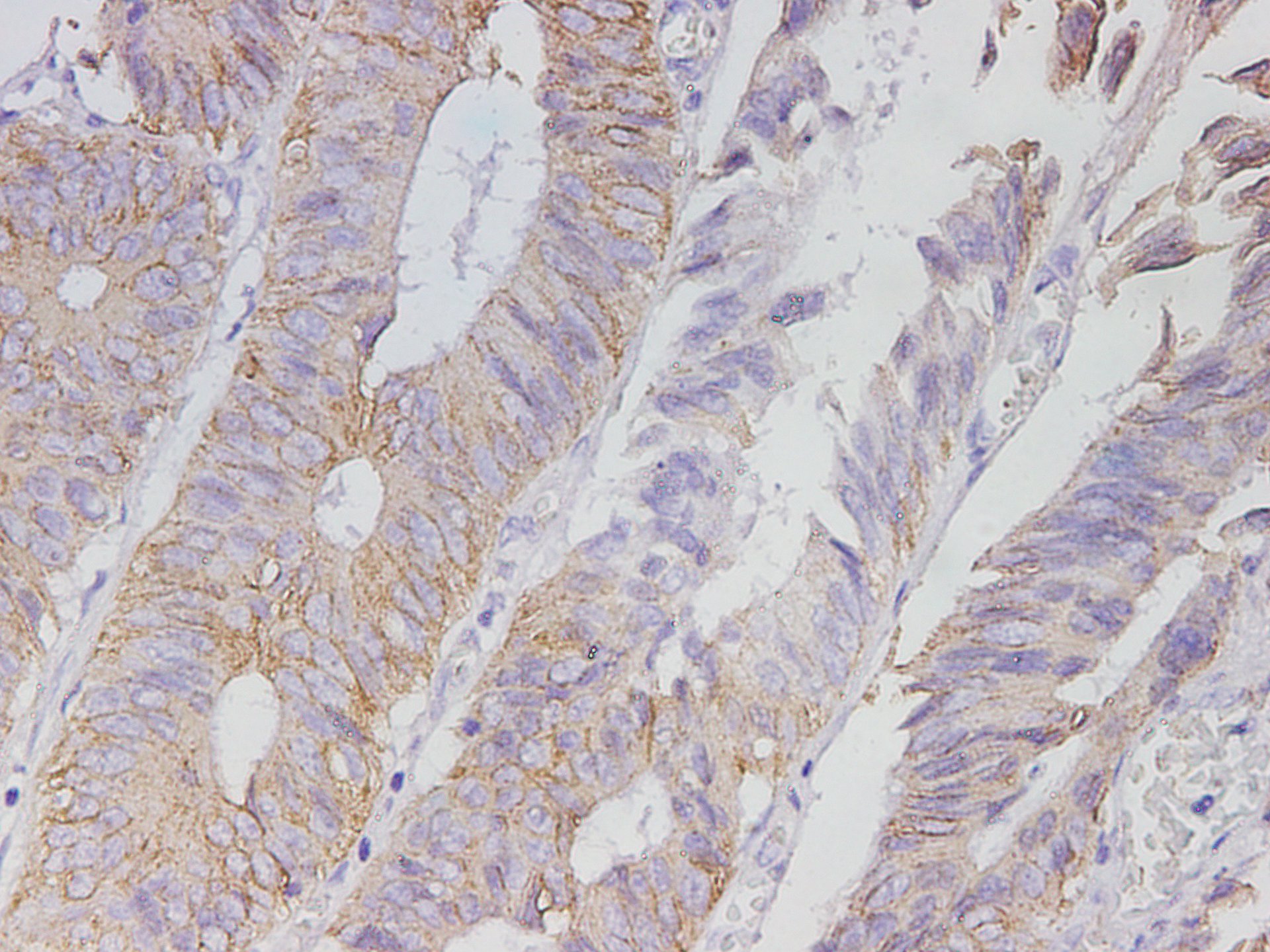 Immunohistochemistry of paraffin-embedded Human colon cancer tissue using AGR1 Polyclonal Antibody at dilution of 1:2900