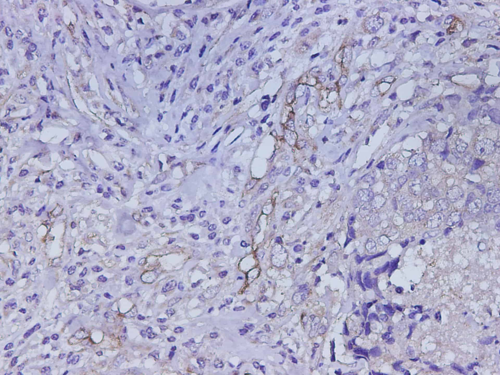 Immunohistochemistry of paraffin-embedded Human breast cancer using Adipoq Polyclonal Antibody at dilution of 1:600