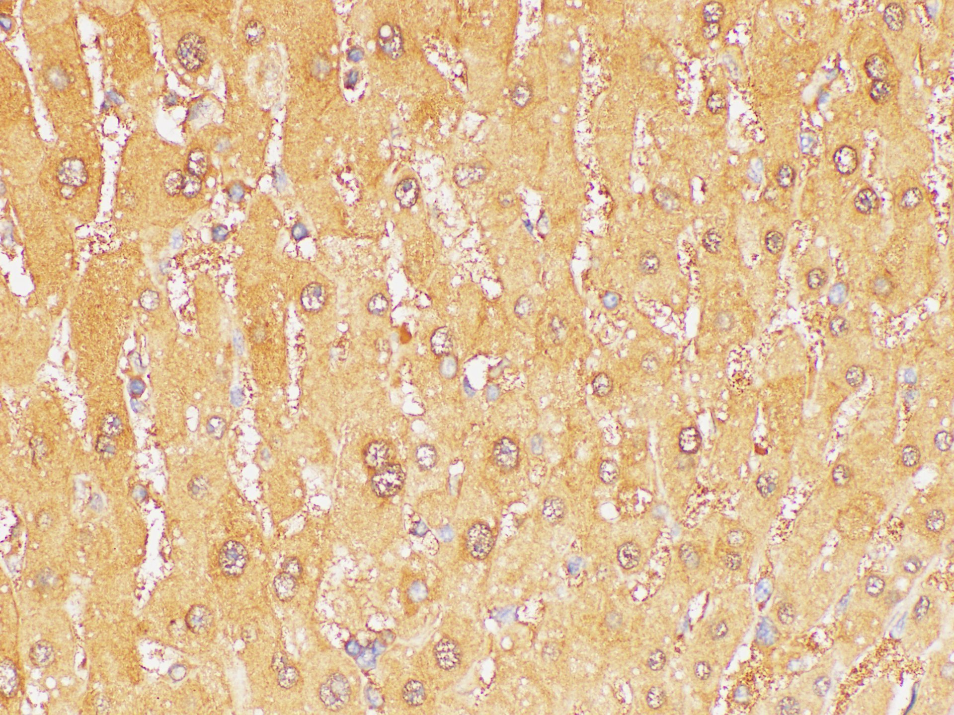 Immunohistochemistry of paraffin-embedded Human liver using GSTA1 Polycloanl Antibody at dilution of 1:200