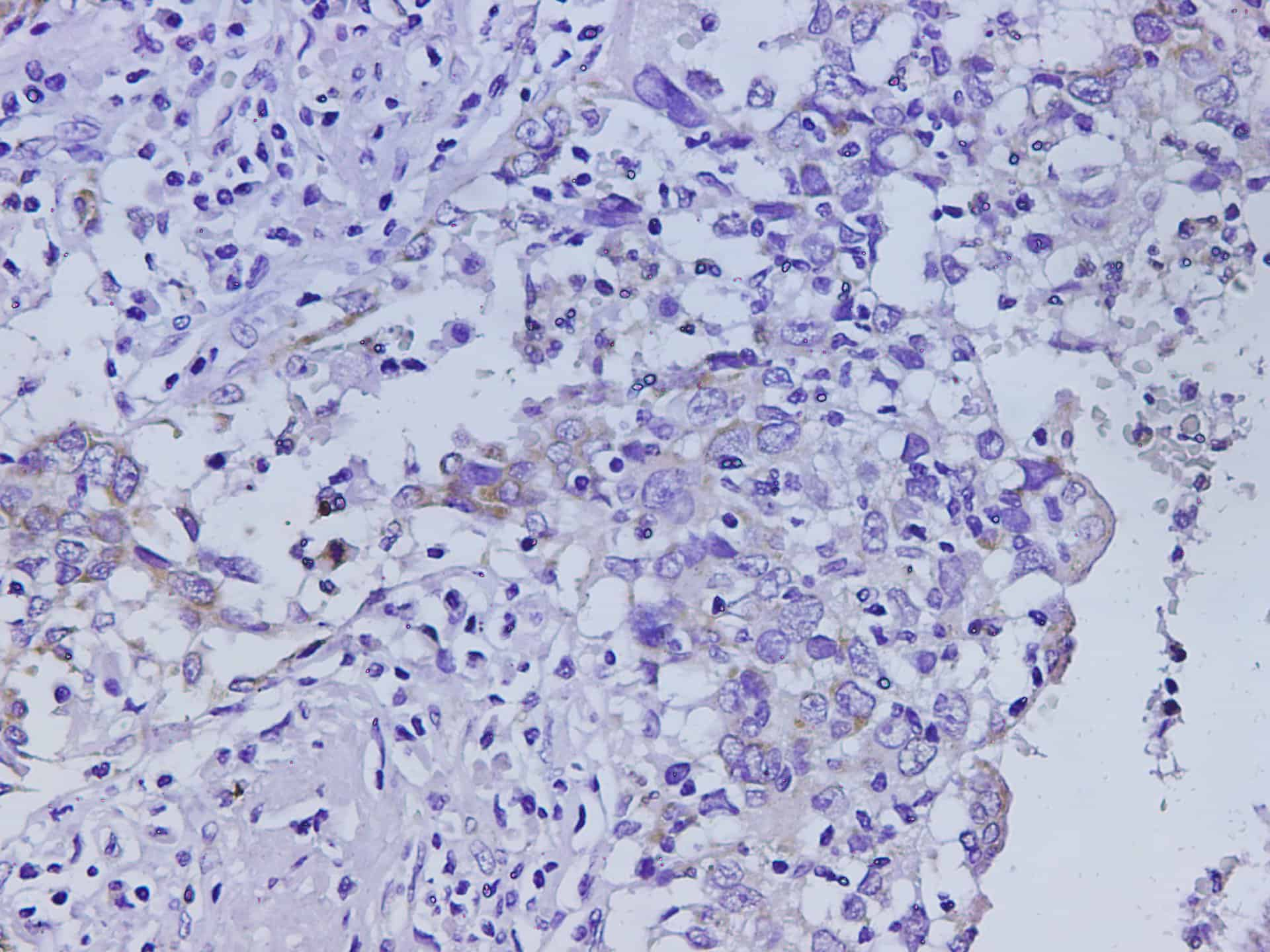 Immunohistochemistry of paraffin-embedded Human lung cancer using Ceacam1 Polyclonal Antibody at dilution of 1:500