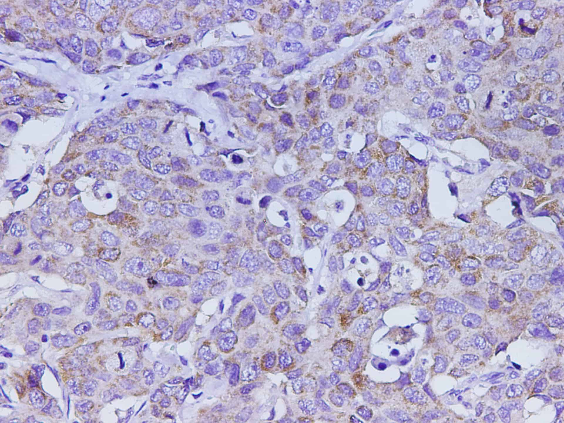 Immunohistochemistry of paraffin-embedded Human stomach cancer using Ceacam1 Polyclonal Antibody at dilution of 1:500