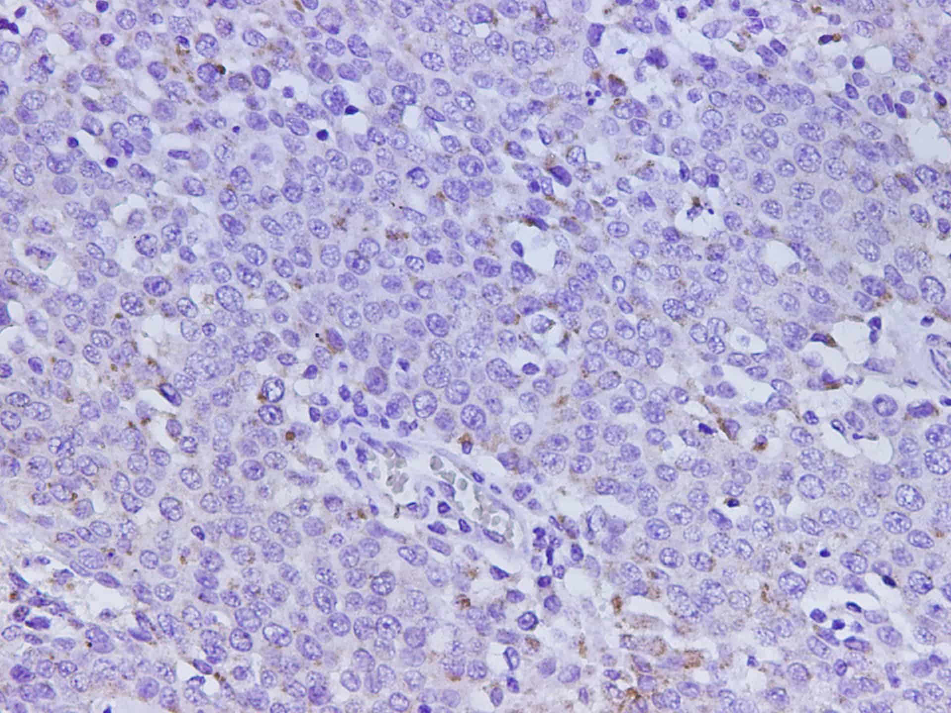 Immunohistochemistry of paraffin-embedded Human ovarian cancer using Ceacam1 Polyclonal Antibody at dilution of 1:500