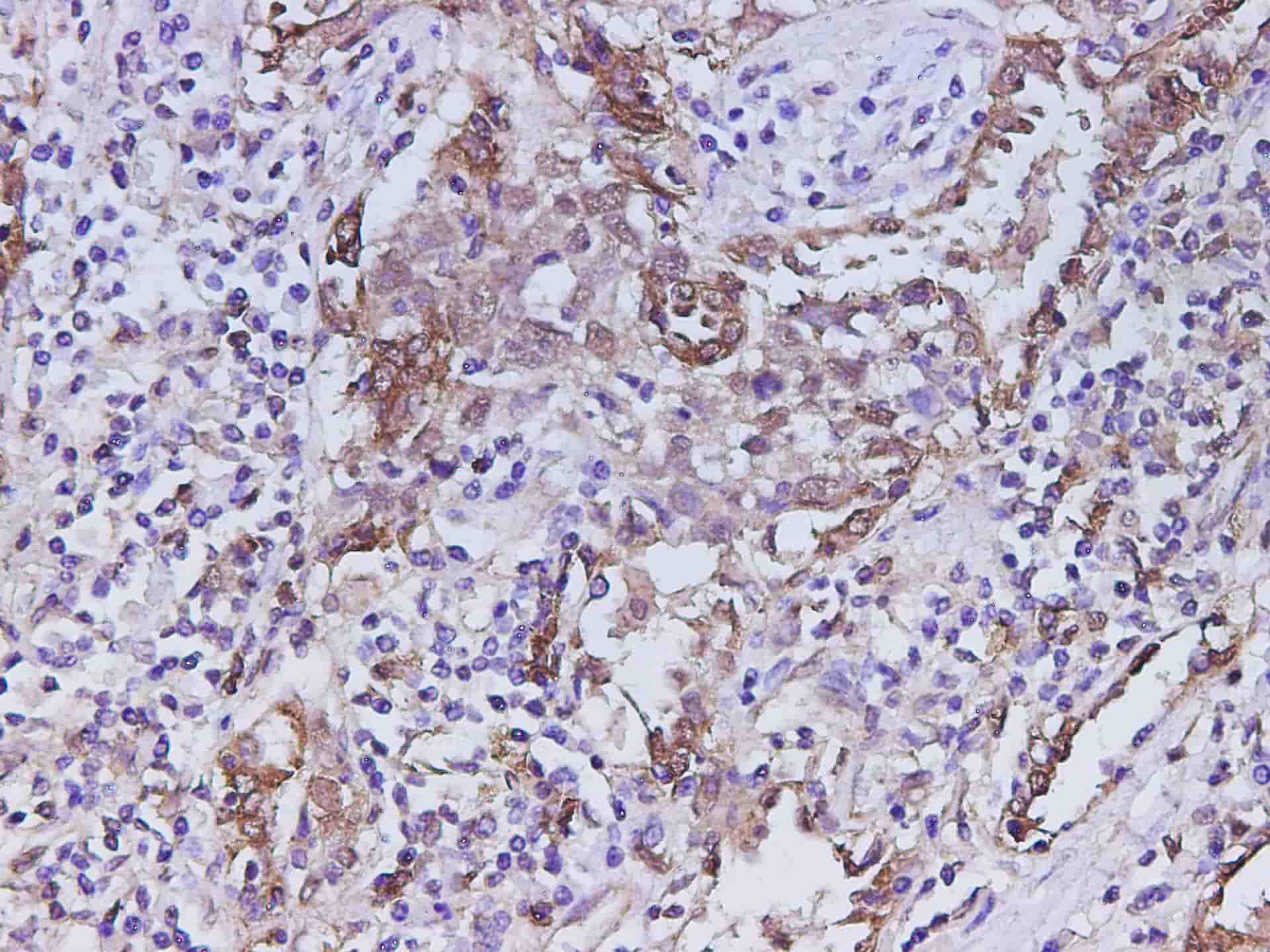 Immunohistochemistry of paraffin-embedded Human lung cancer using S100A11 Polyclonal Antibody at dilution of 1:400