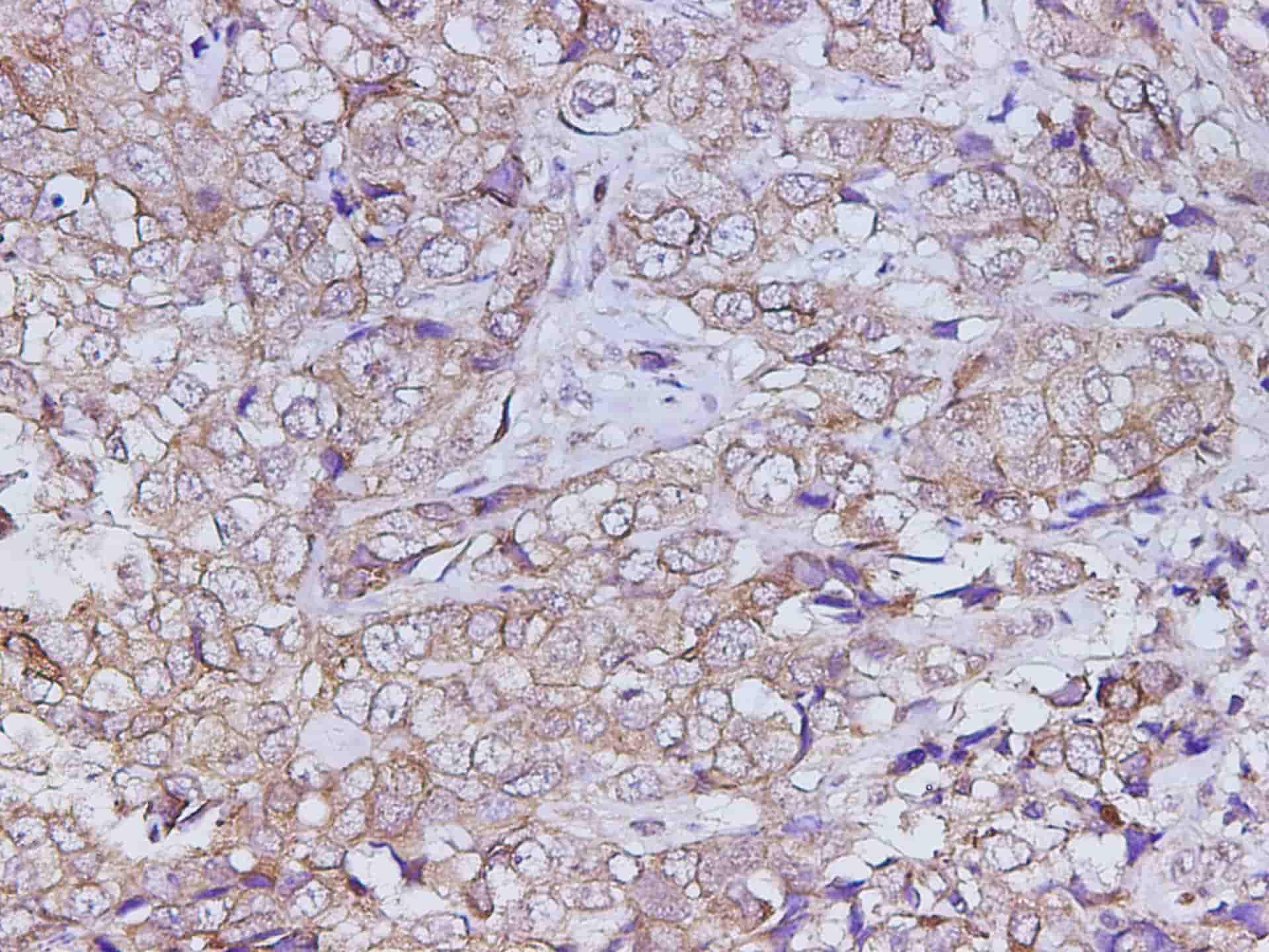 Immunohistochemistry of paraffin-embedded Human breast cancer using E-Cadherin Polyclonal Antibody at dilution of 1:200