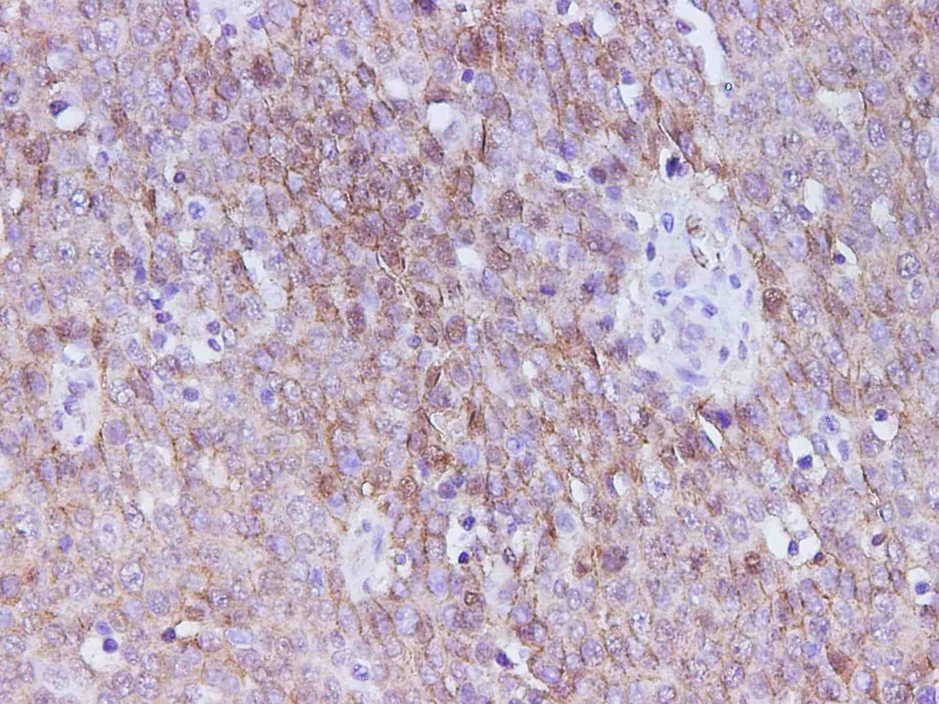 Immunohistochemistry of paraffin-embedded Human ovarian cancer
 using E-Cadherin Polyclonal Antibody at dilution of 1:200