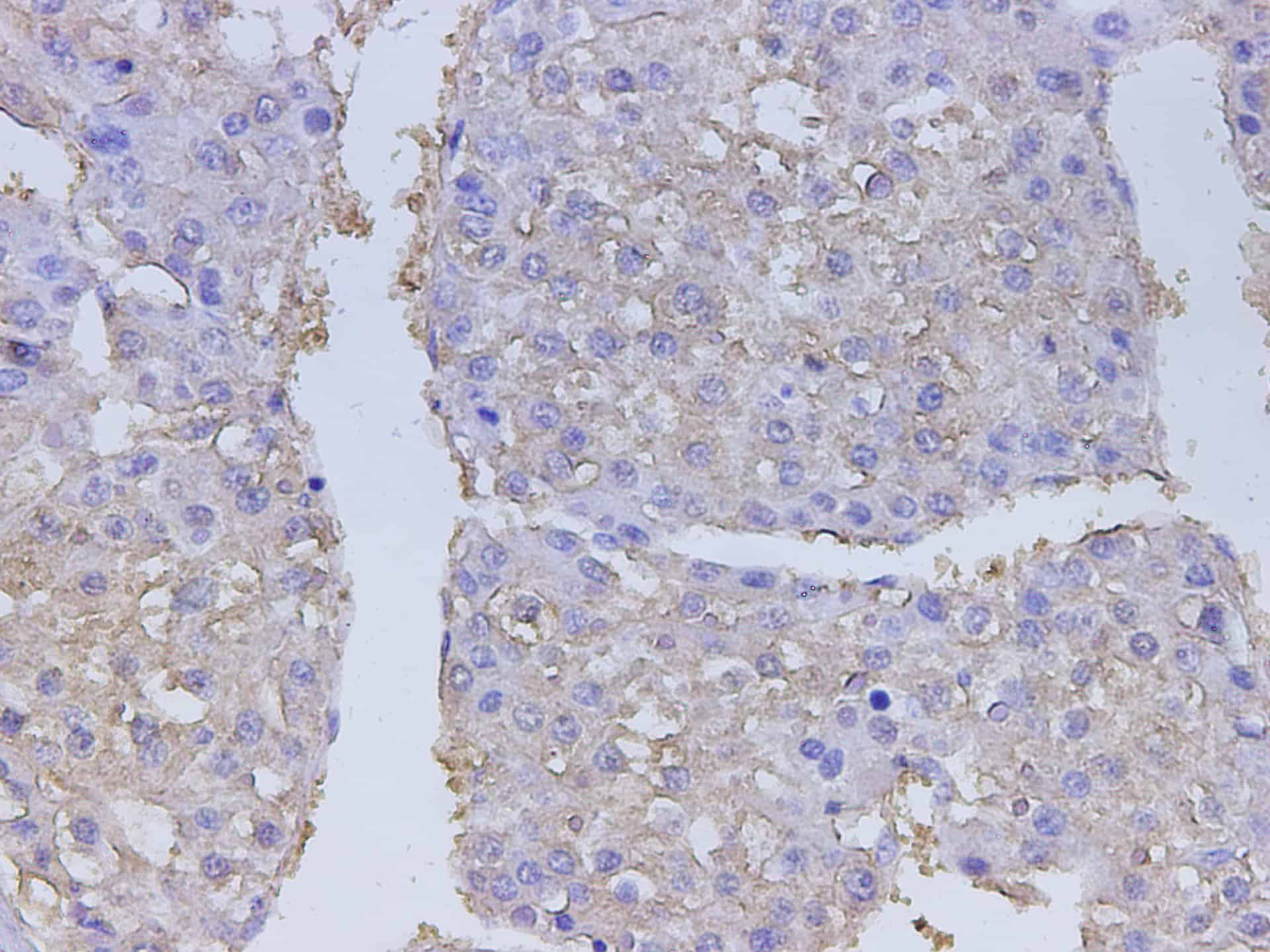 Immunohistochemistry of paraffin-embedded Human liver cancer using LDHA Polyclonal Antibody at dilution of 1:400