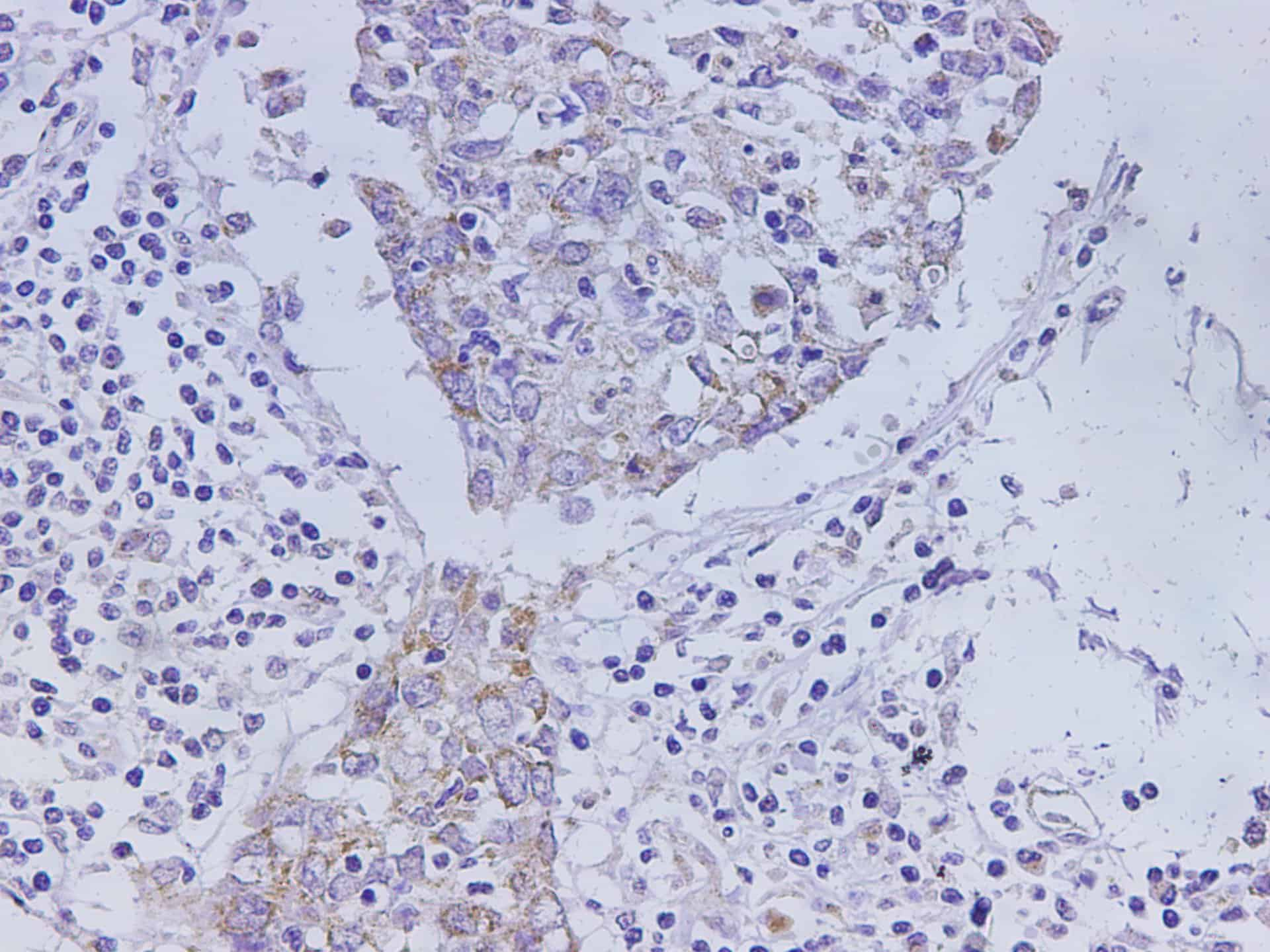 Immunohistochemistry of paraffin-embedded Human lung cancer using CEACAM-1 Polyclonal Antibody at dilution of 1:1000