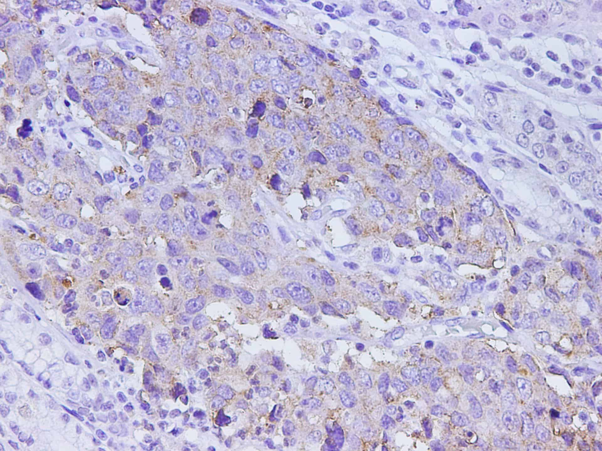 Immunohistochemistry of paraffin-embedded Human stomach cancer using CEACAM-1 Polyclonal Antibody at dilution of 1:1000