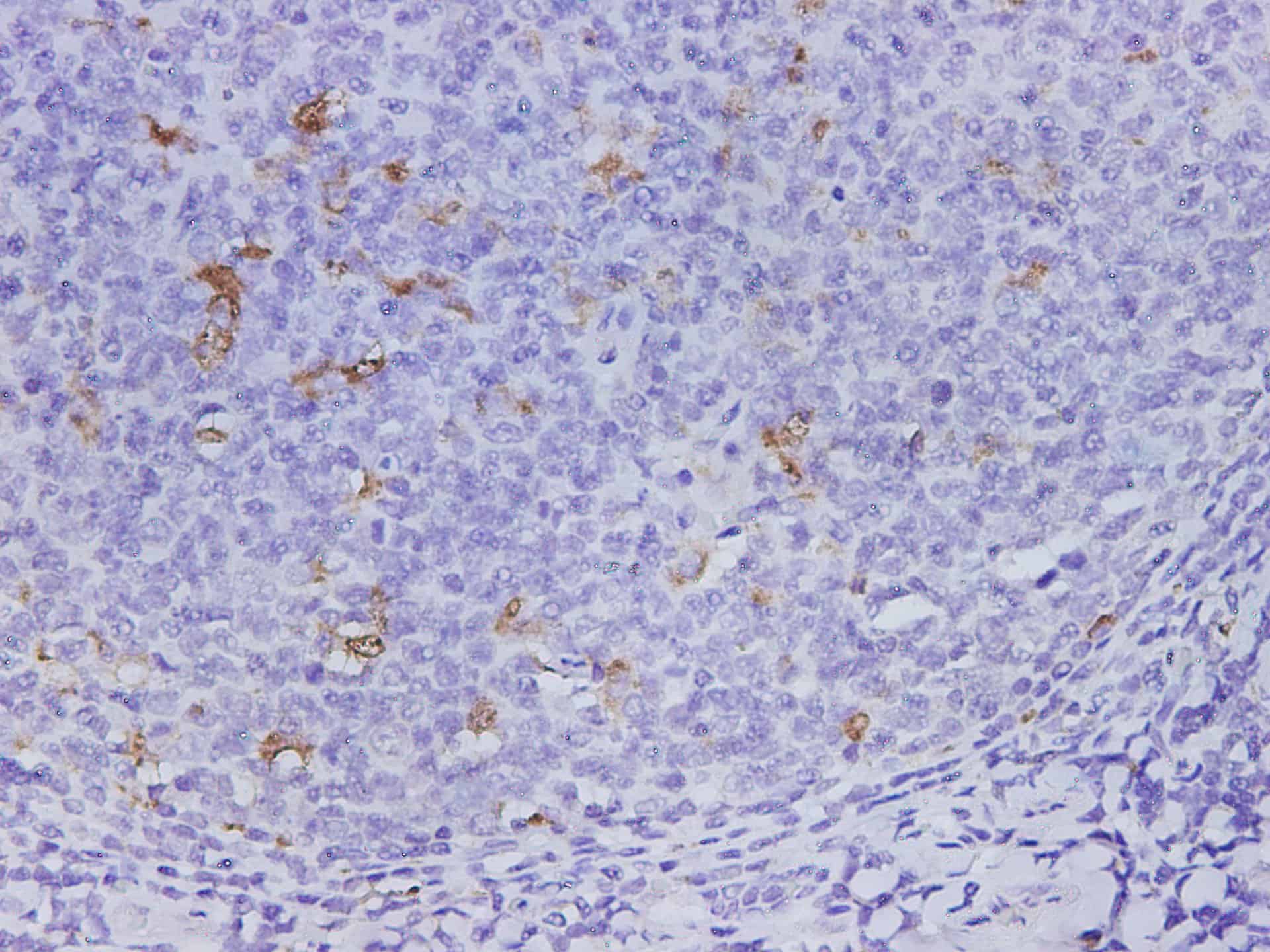 Immunohistochemistry of paraffin-embedded Human tonsil using CD68 Polyclonal Antibody at dilution of 1:500