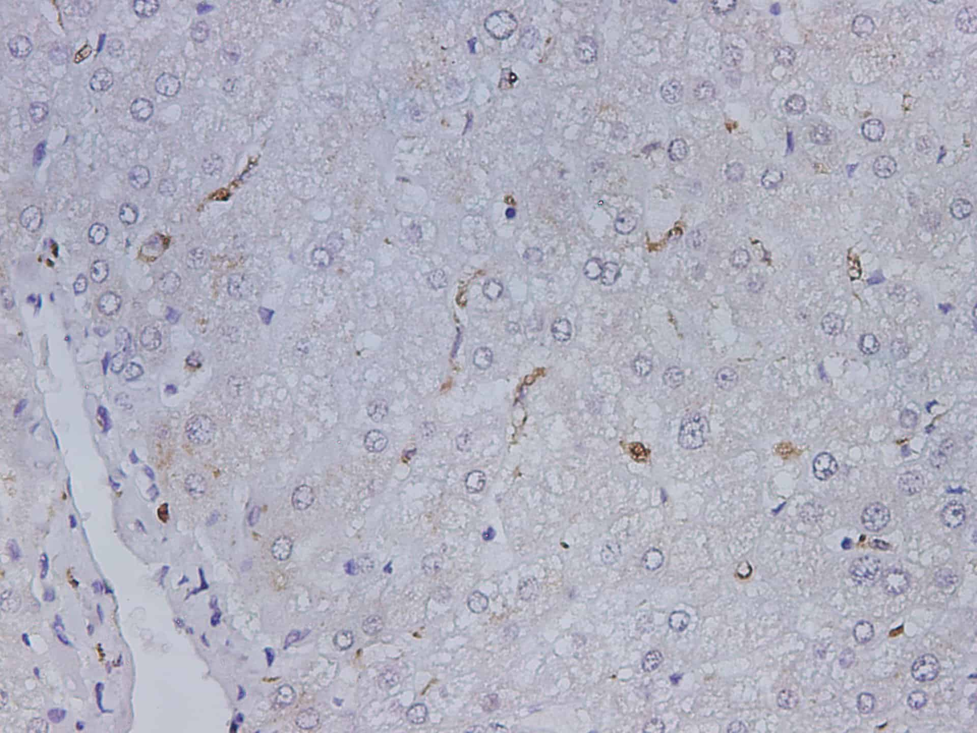 Immunohistochemistry of paraffin-embedded Human liver using CD68 Polyclonal Antibody at dilution of 1:500