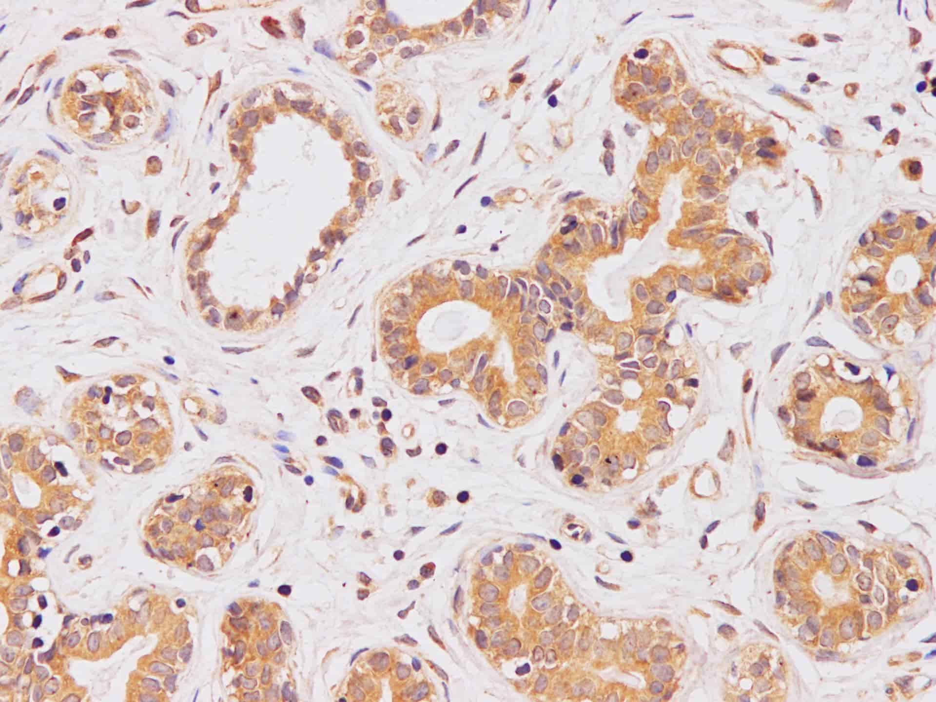 Immunohistochemistry of paraffin-embedded Human breast using PIK3CA Polyclonal Antibody at dilution of 1:100