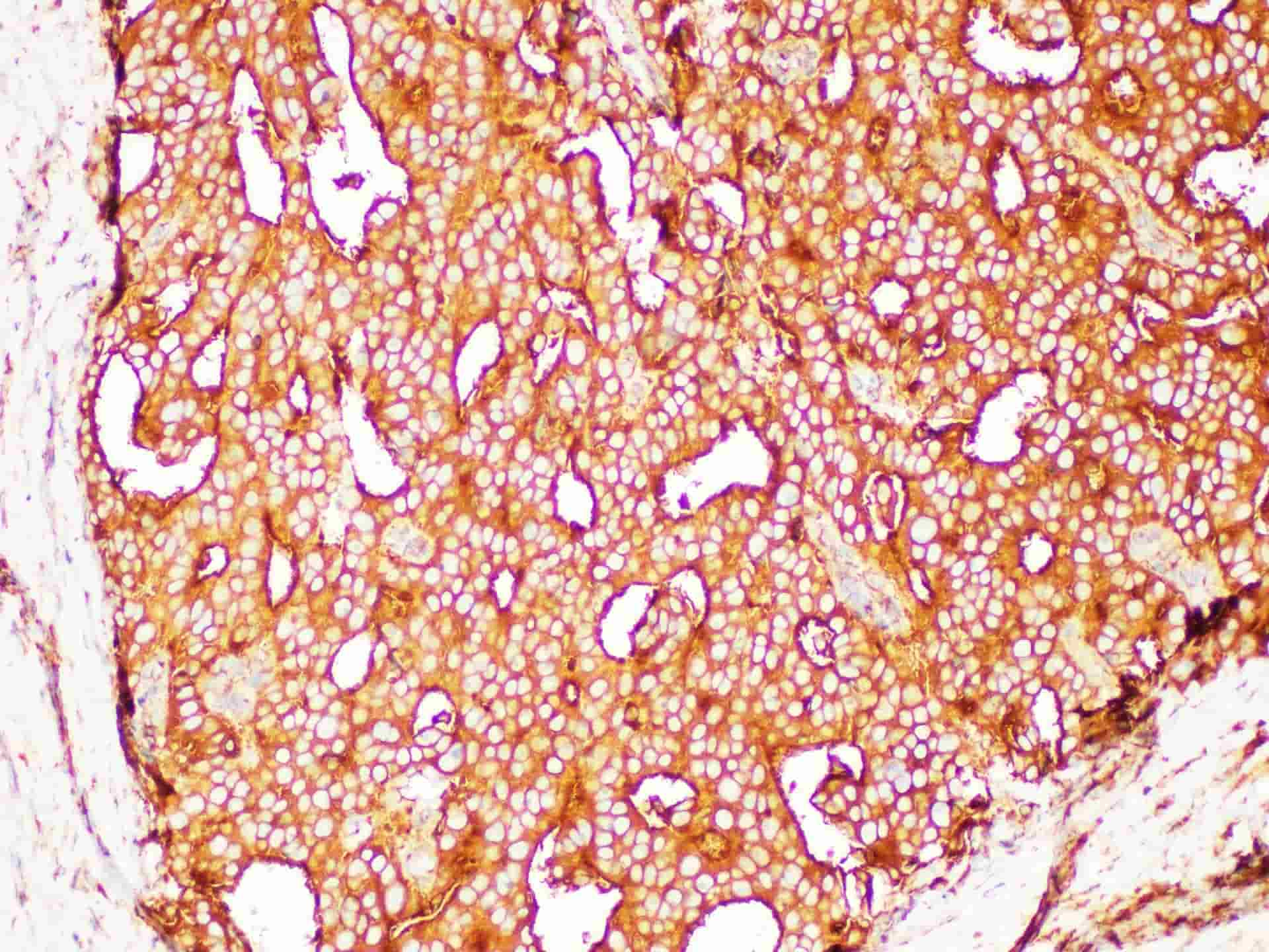 Immunohistochemistry of paraffin-embedded Human prostate cancer using PSMA Polycloanl Antibody at dilution of 1:200