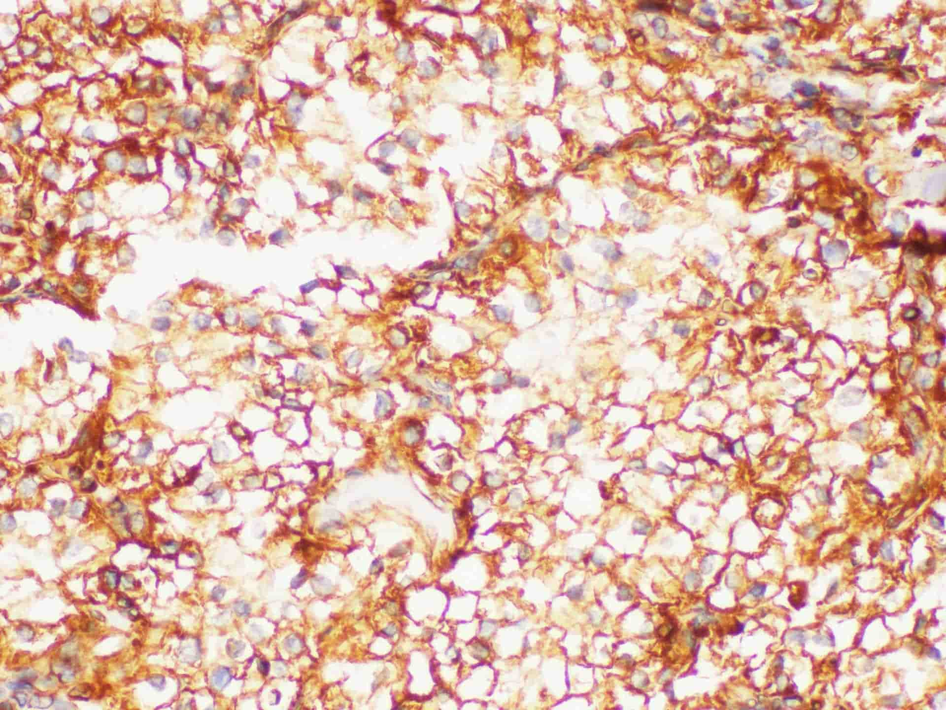 Immunohistochemistry of paraffin-embedded Human kidney cancer using PSMA Polycloanl Antibody at dilution of 1:200