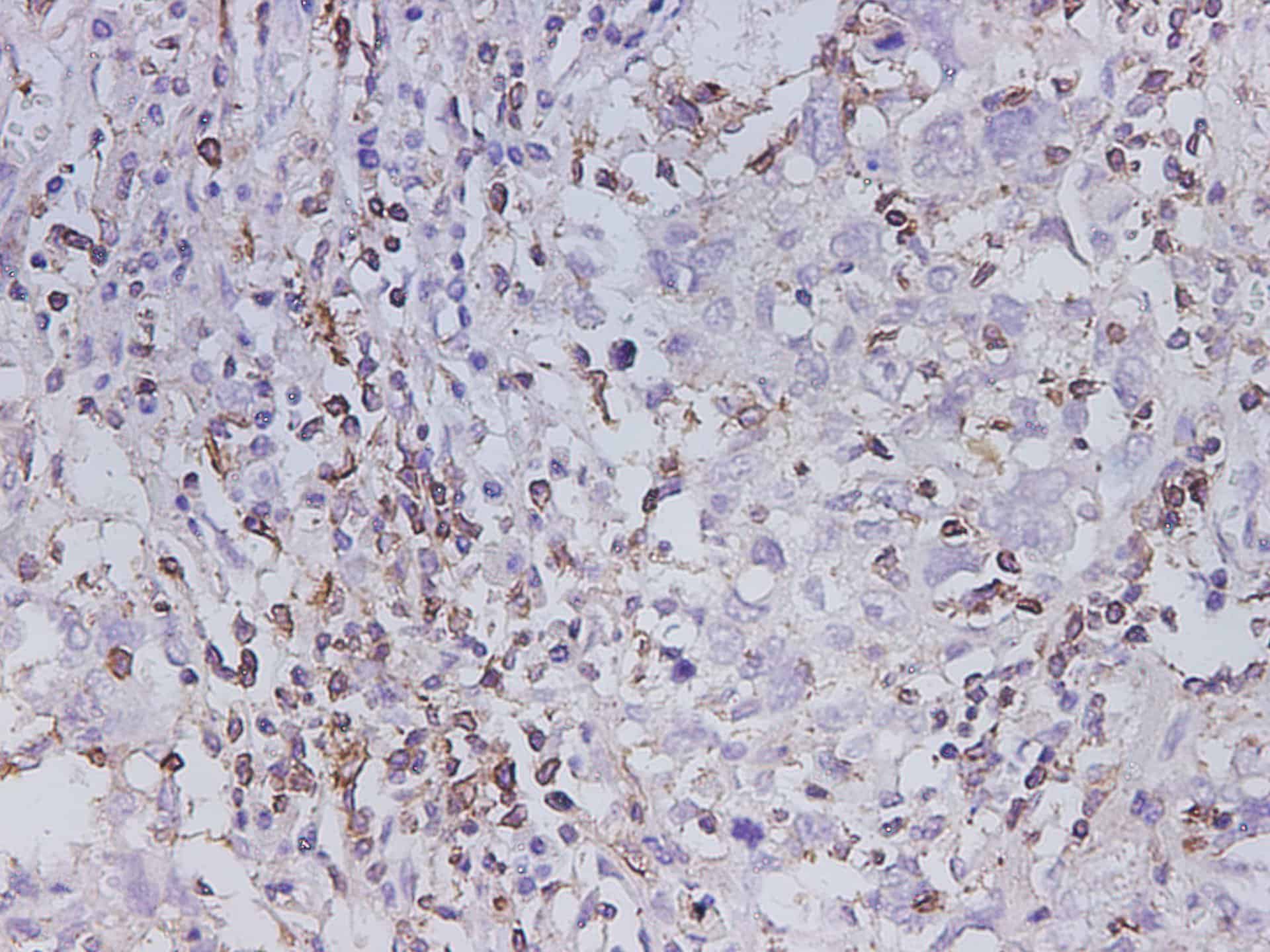 Immunohistochemistry of paraffin-embedded Human lung cancer using MMP-1 Polyclonal Antibody at dilution of 1:600