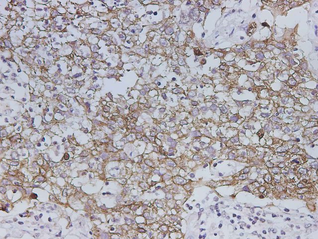 Immunohistochemistry of paraffin-embedded Human lung cancer using Krt19 Polyclonal Antibody at dilution of 1:300