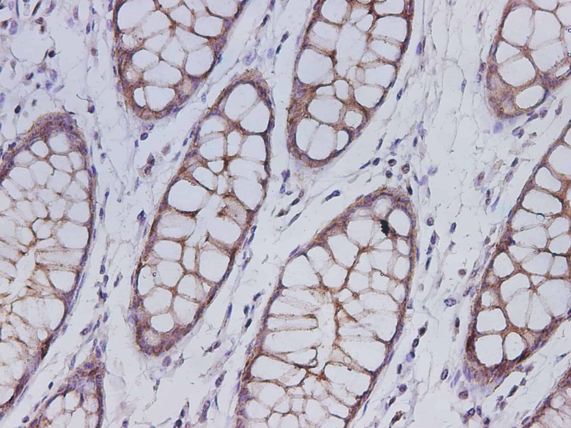 Immunohistochemistry of paraffin-embedded Human colon using Krt19 Polyclonal Antibody at dilution of 1:300