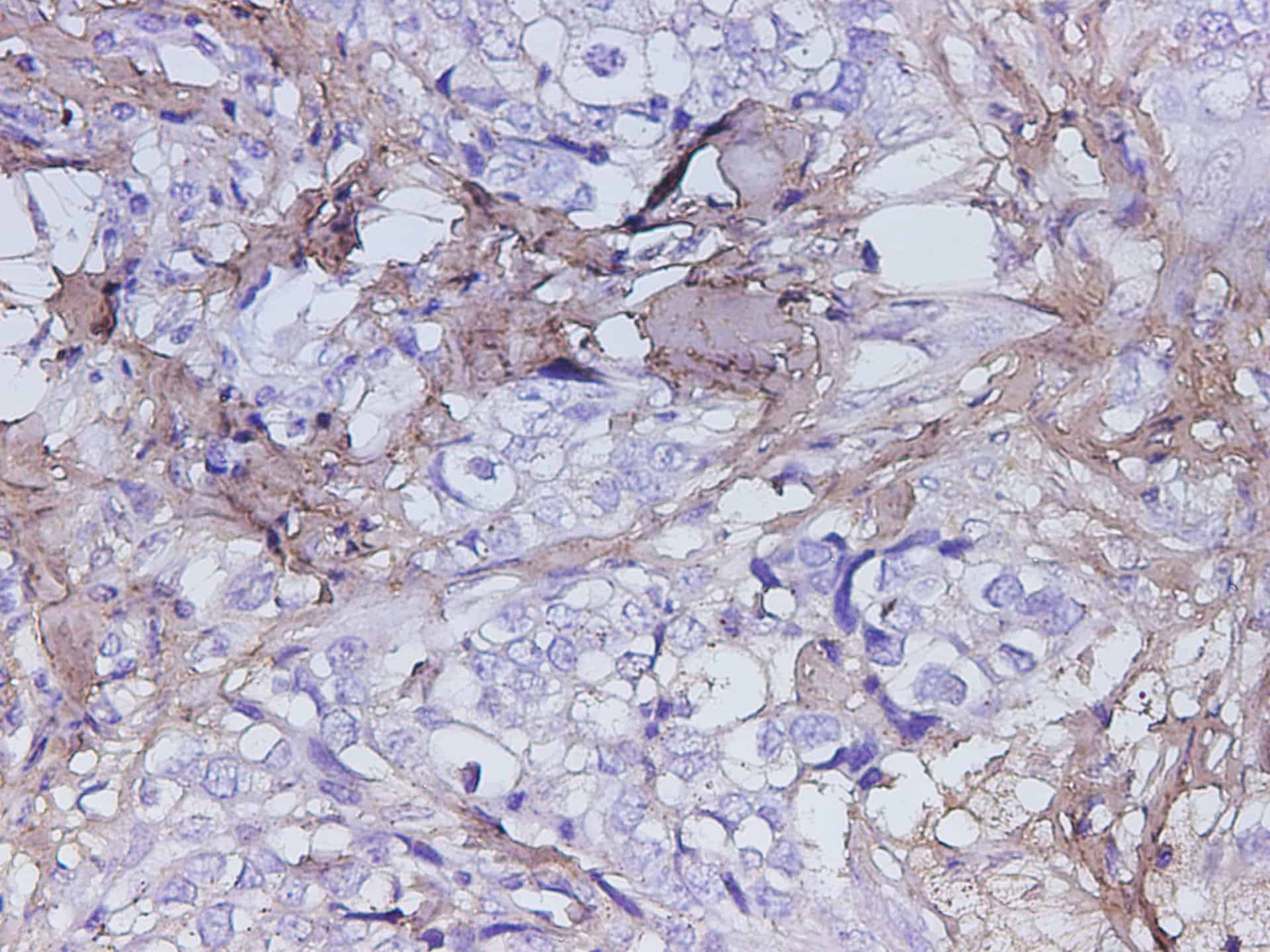 Immunohistochemistry of paraffin-embedded Human breast cancer using POSTN Polyclonal Antibody at dilution of 1:200