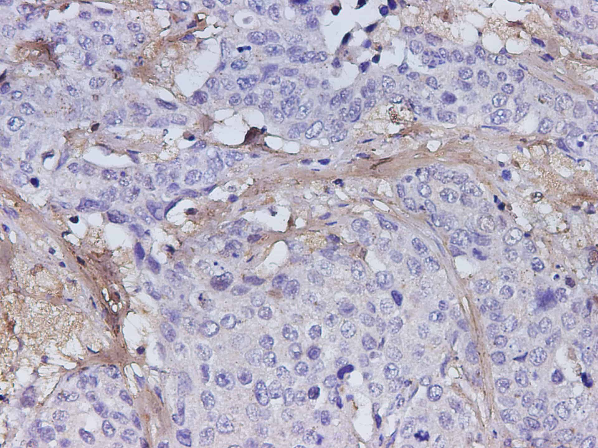 Immunohistochemistry of paraffin-embedded Human stomach cancer using POSTN Polyclonal Antibody at dilution of 1:200