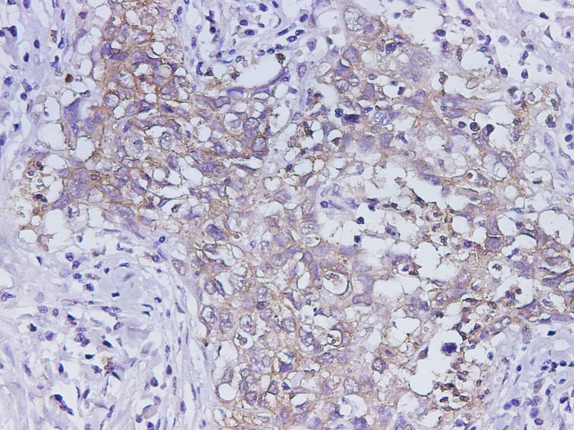 Immunohistochemistry of paraffin-embedded Human lung cancer using EPCAM Polyclonal Antibody at dilution of 1:100