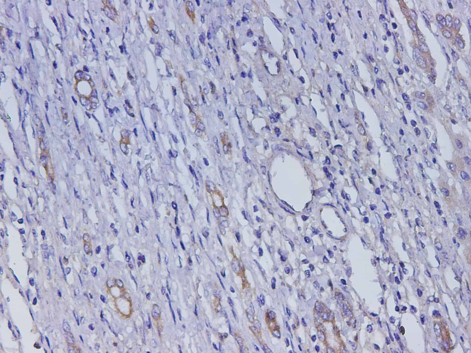 Immunohistochemistry of paraffin-embedded Human liver cancer using Afp Polyclonal Antibody at dilution of 1:600