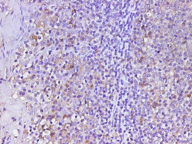 Immunohistochemistry of paraffin-embedded Human tonsil using CD74 Polyclonal Antibody at dilution of 1:400