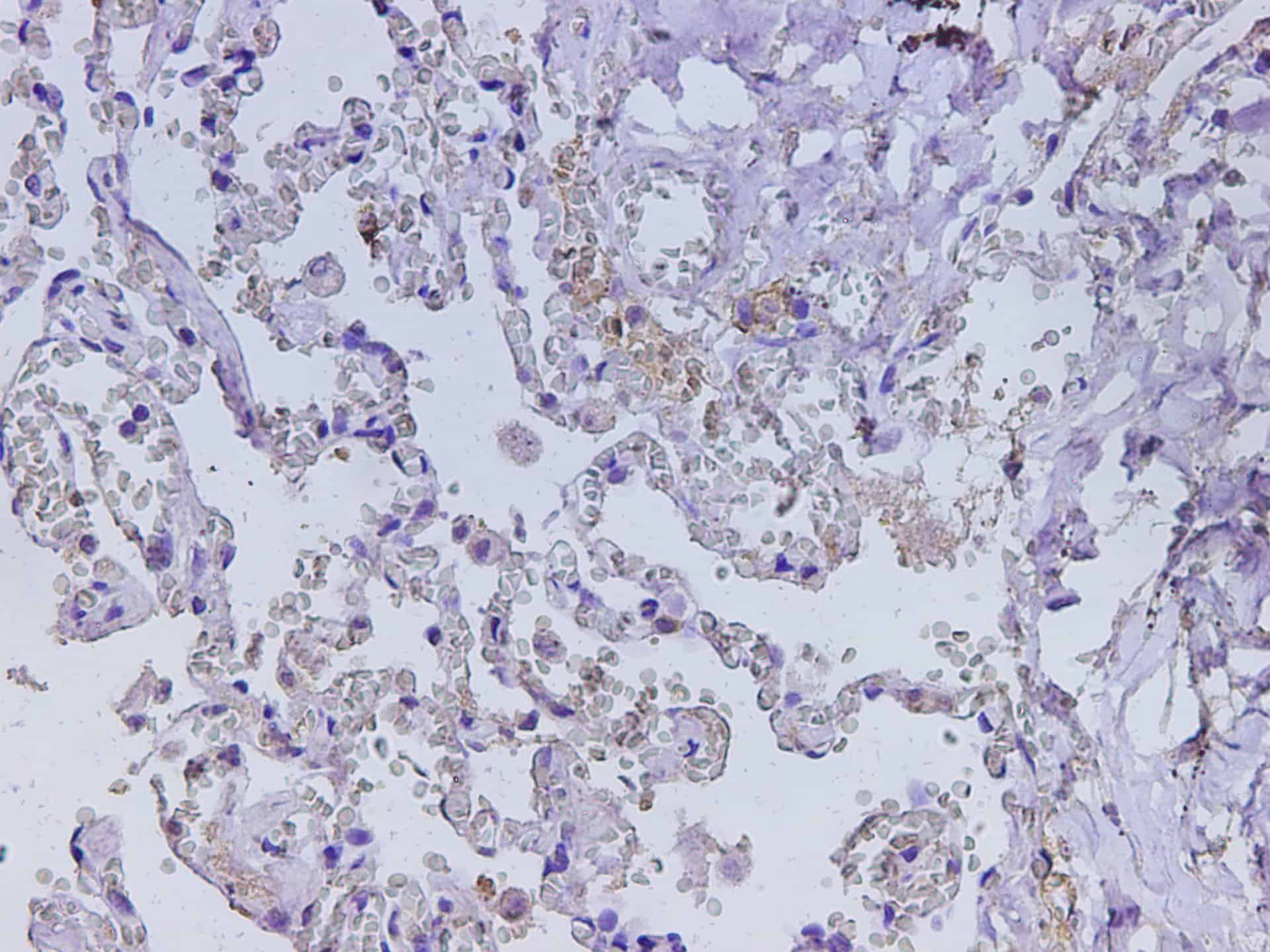 Immunohistochemistry of paraffin-embedded Human lung using CD74 Polyclonal Antibody at dilution of 1:400