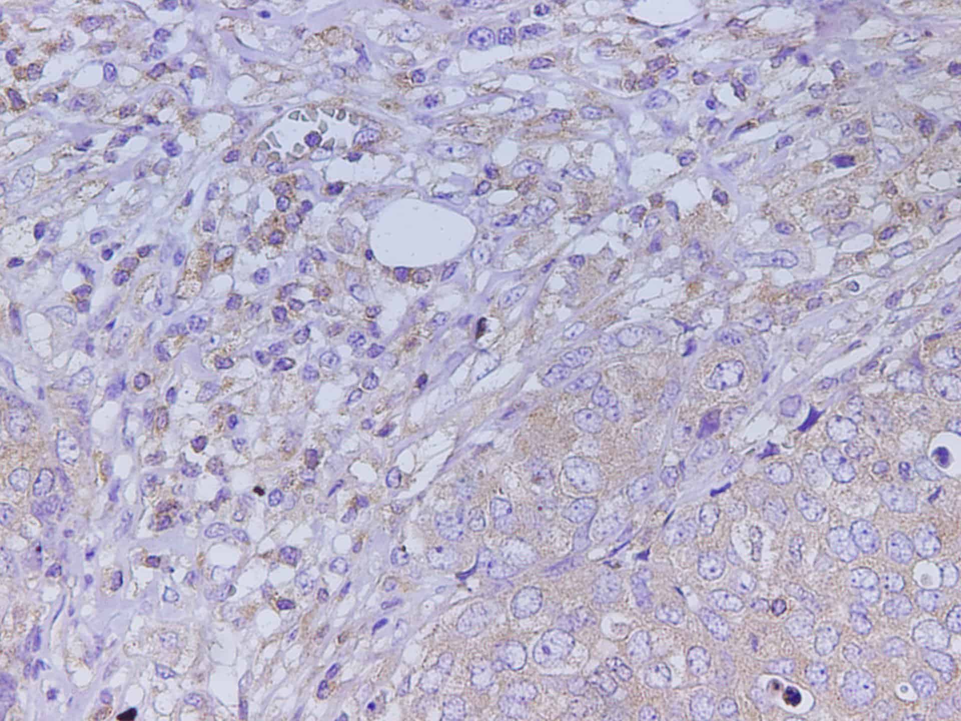 Immunohistochemistry of paraffin-embedded Human breast cancer using KLK2 Polyclonal Antibody at dilution of 1:2000