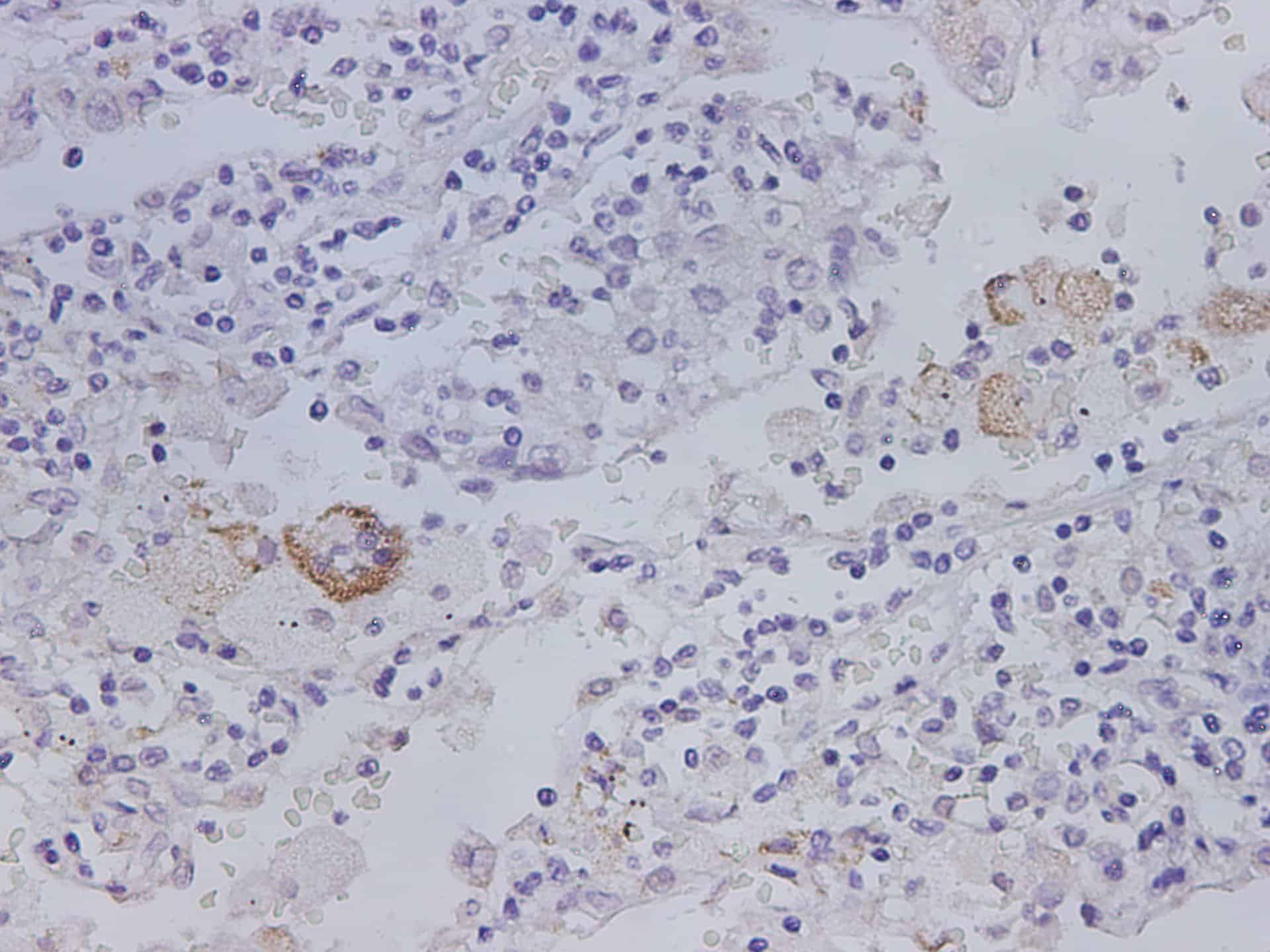 Immunohistochemistry of paraffin-embedded Human lung cancer using MMP-1 Polyclonal Antibody at dilution of 1:1200