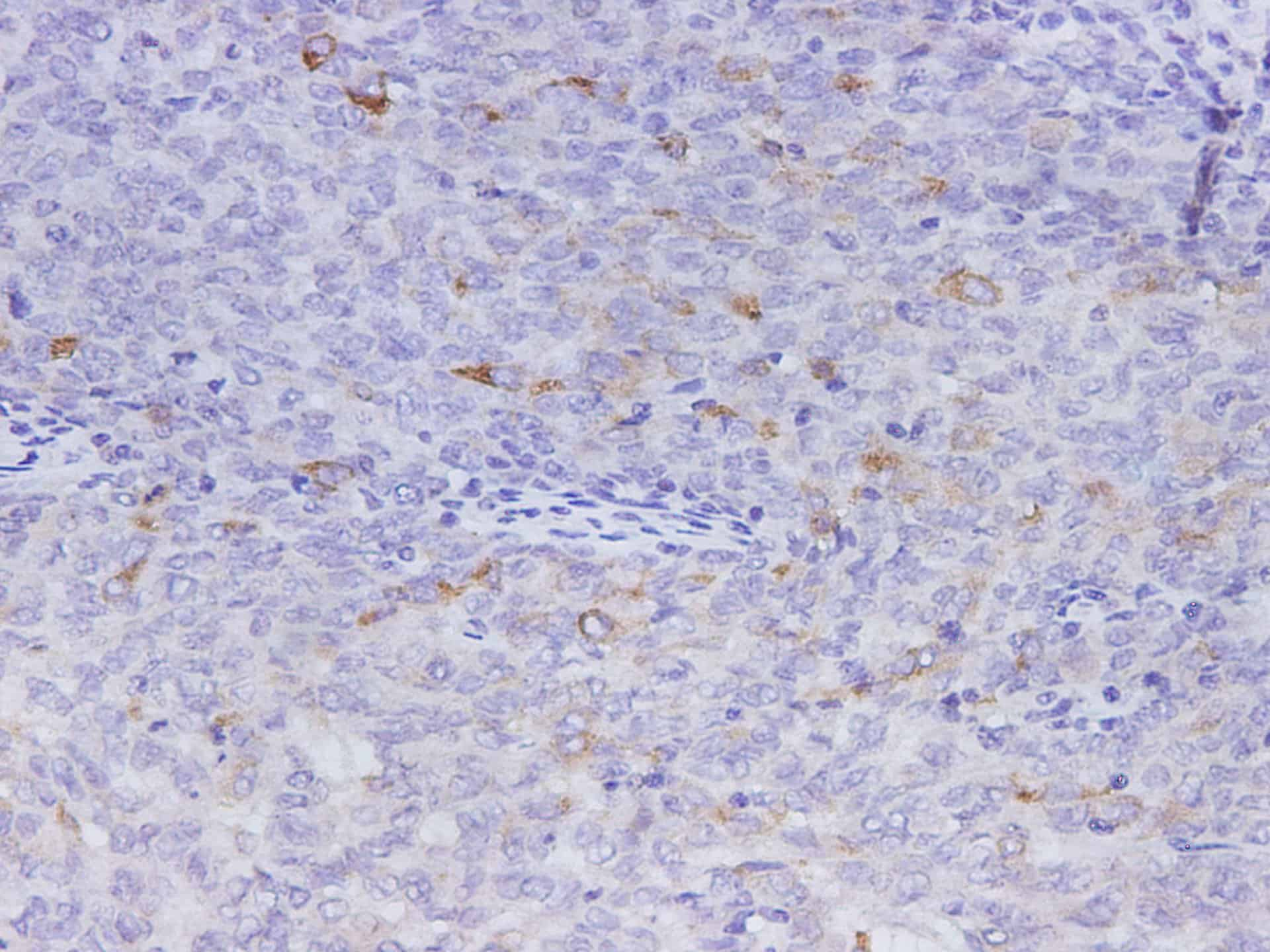 Immunohistochemistry of paraffin-embedded Human cervical cancer using MMP-1 Polyclonal Antibody at dilution of 1:1200