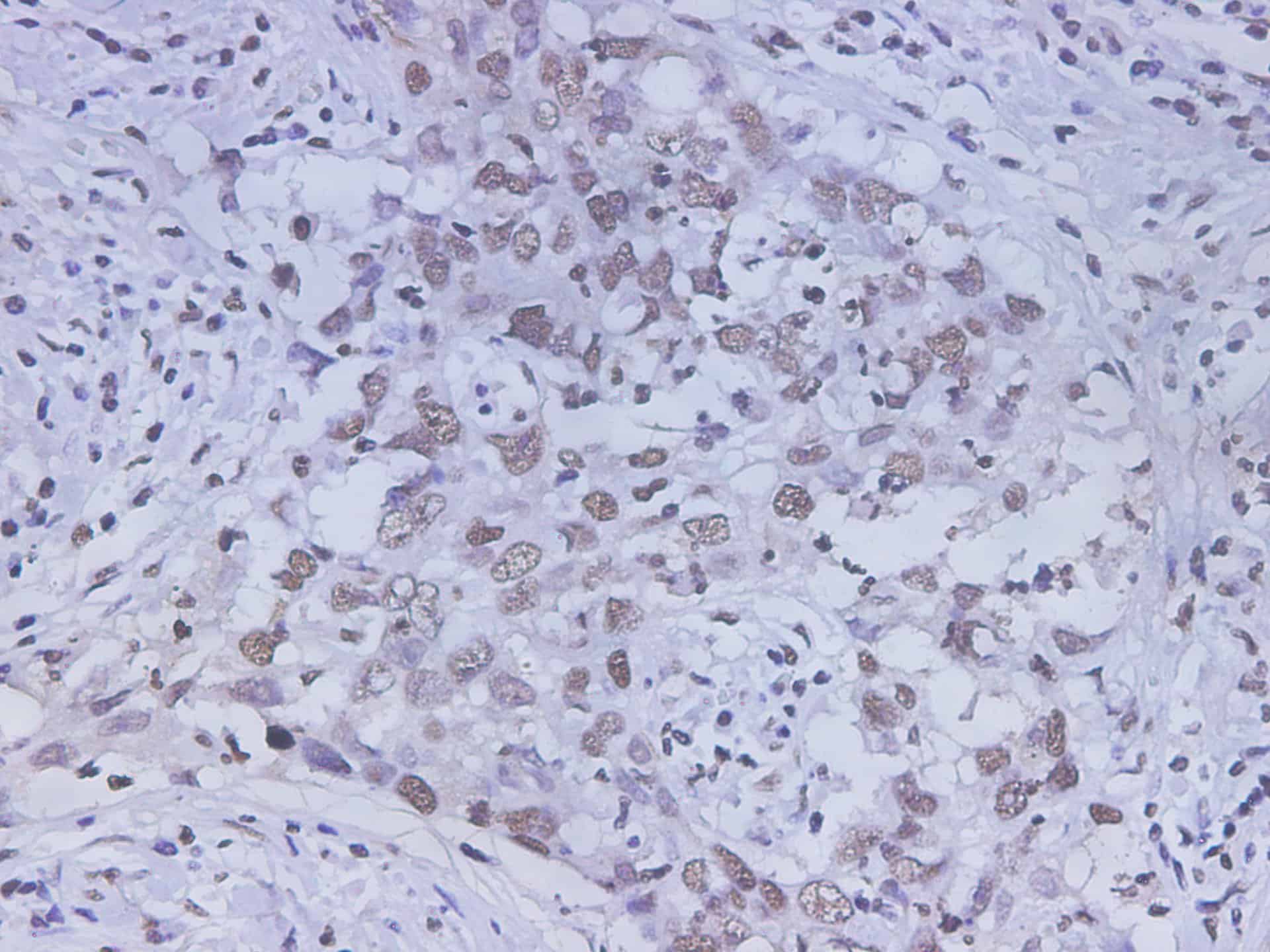 Immunohistochemistry of paraffin-embedded Human lung cancer using HMGB-1 Polyclonal Antibody at dilution of 1:350