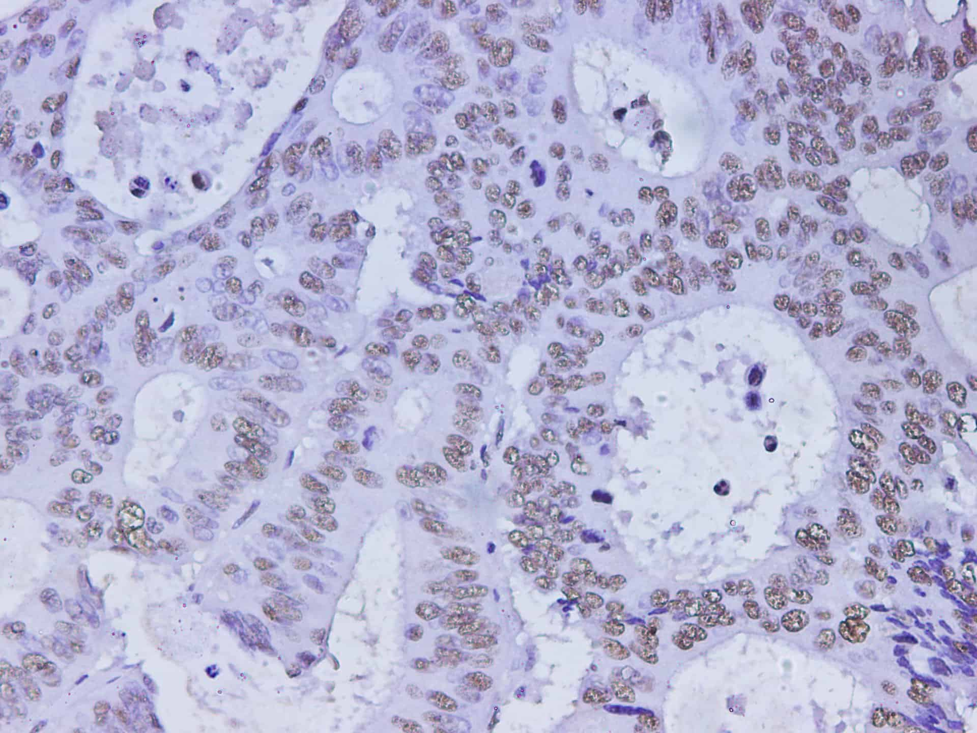 Immunohistochemistry of paraffin-embedded Human colon cancer using HMGB-1 Polyclonal Antibody at dilution of 1:350