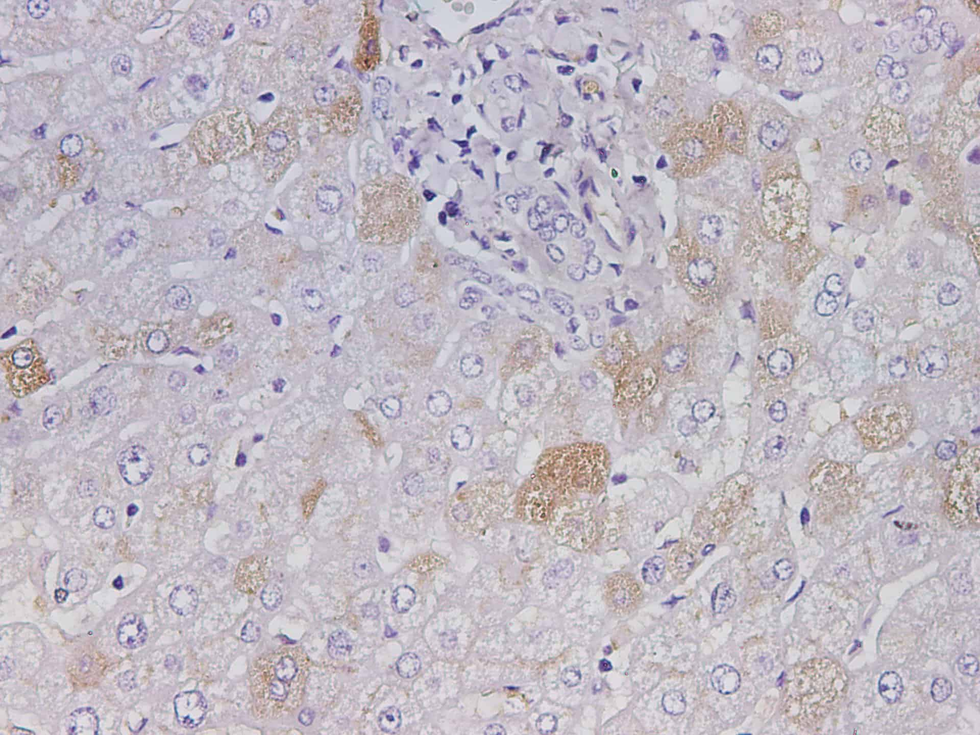 Immunohistochemistry of paraffin-embedded Human liver using ALB Polyclonal Antibody at dilution of 1:800